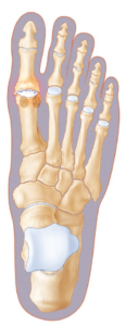 hallux rigidus