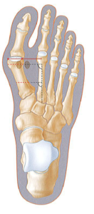 Hallux valgus