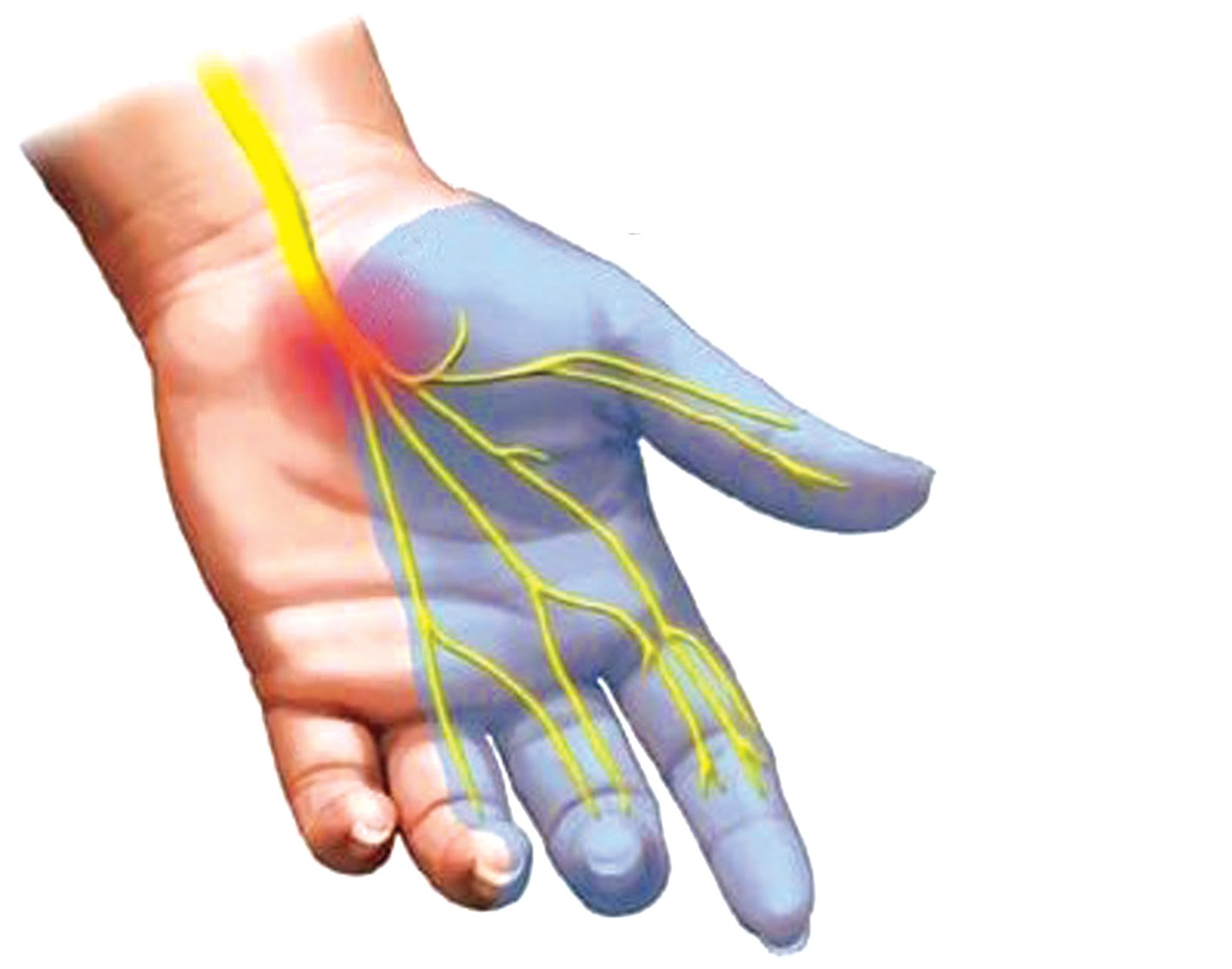Syndrome du canal carpien et interventions possibles